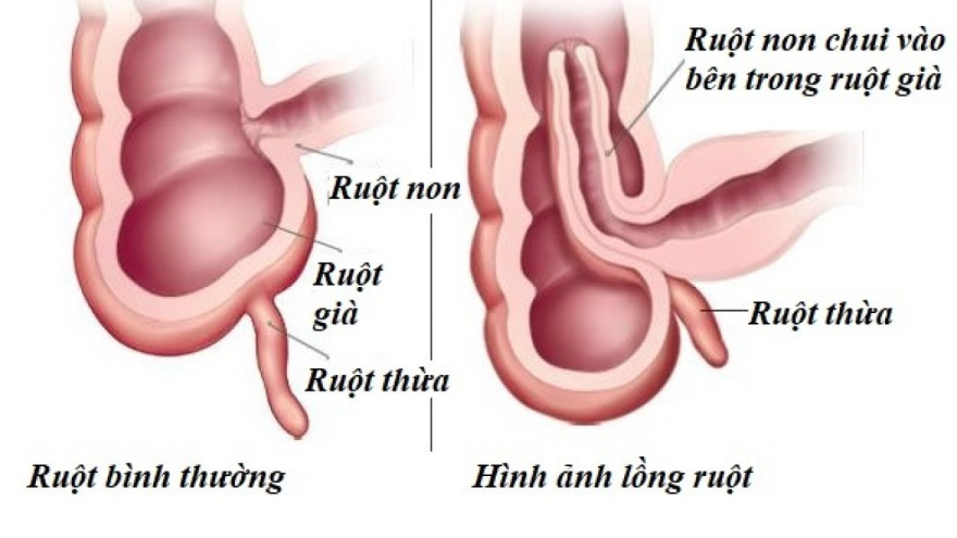 Những điều Cần Biết Về Bệnh Lồng Ruột ở Trẻ Em Bệnh Viện Sản Nhi Bắc Ninh