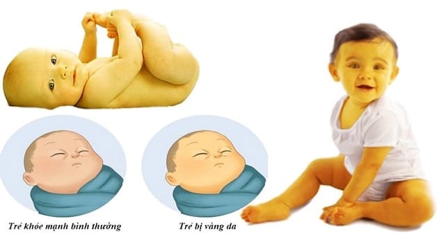 4. Các biện pháp điều trị vàng da sinh lý