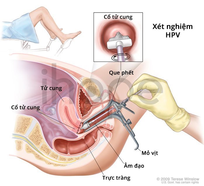 Kiểm tra HPV là gì? Hướng dẫn chi tiết từ quy trình đến ý nghĩa kết quả