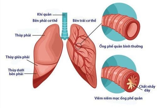 4. Cách chăm sóc trẻ bị viêm phế quản mãn tính tại nhà